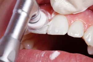 Профессиональная чистка зубов у стоматолога: на что обратить внимание
