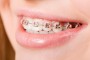 Young woman with brackets on teeth