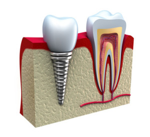 Anatomy of healthy teeth and dental implant in jaw bone.